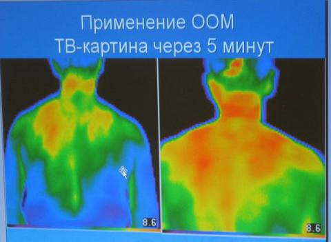 Potilaasta otetut lämpökamerakuvat ennen ja jälkeen otsoni-autohemoterapian